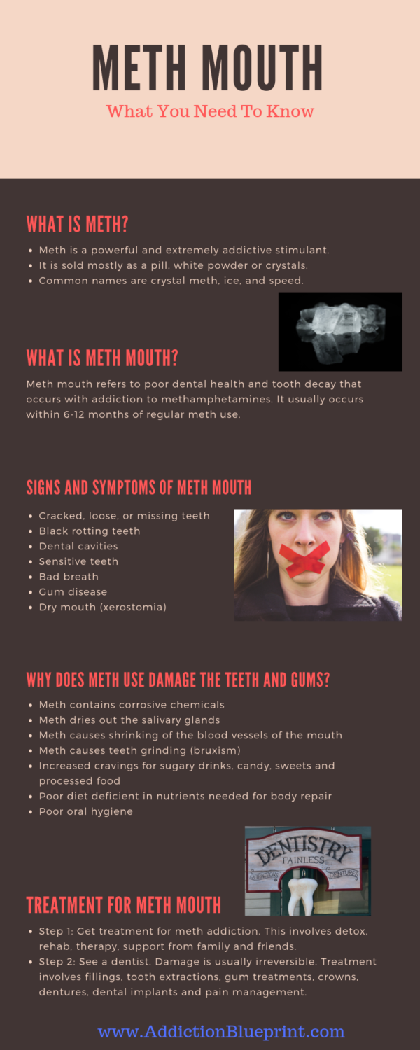 Meth Mouth What You Need To Know Addiction Blueprint